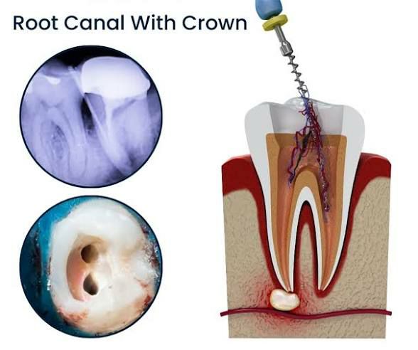 Dental Xray