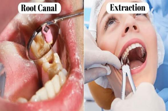 Dental Extractions