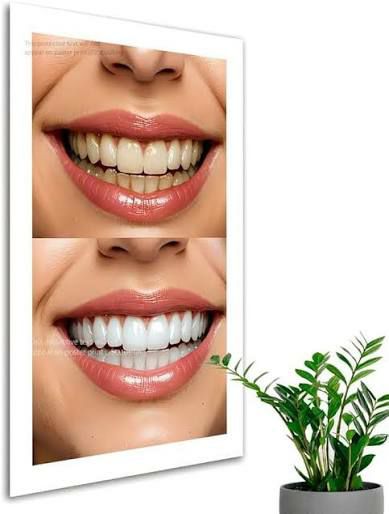 TEETH WHITENING