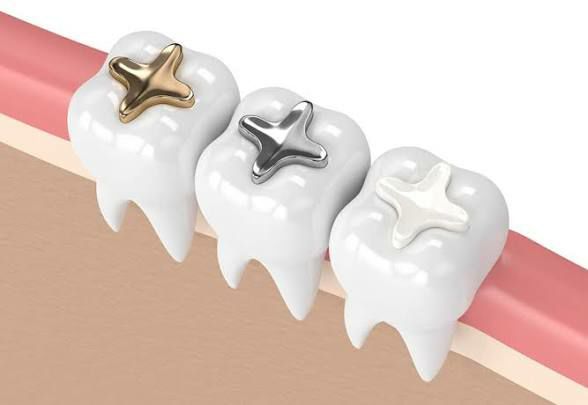 DENTAL FILLINGS