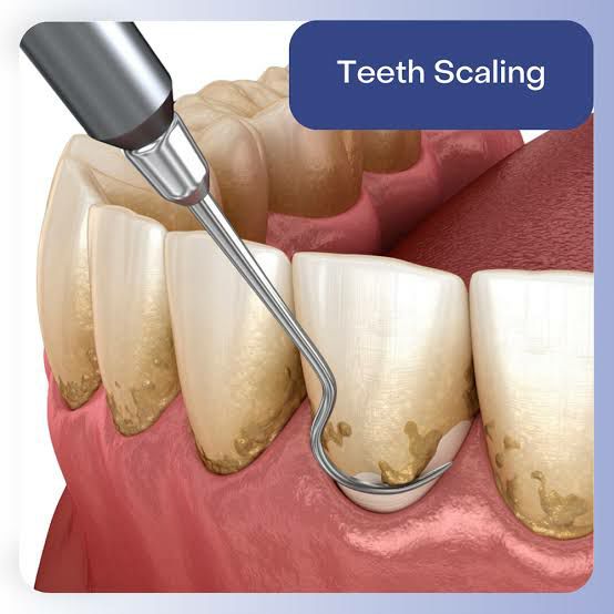 CLEANING OF TEETH