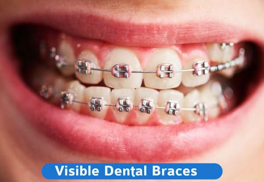 TEETH WIRE TREAMENT ORTHODONTICS
