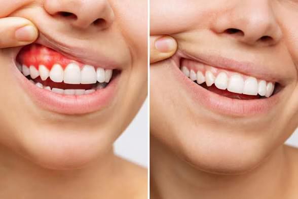 PERIODONTICS TREATMENT