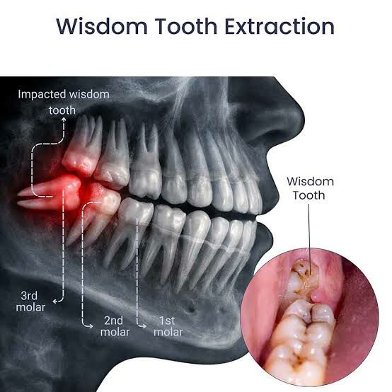 EXRACTION WISDOM TOOTH