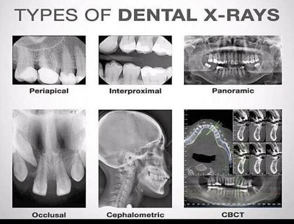 Dental Xrays