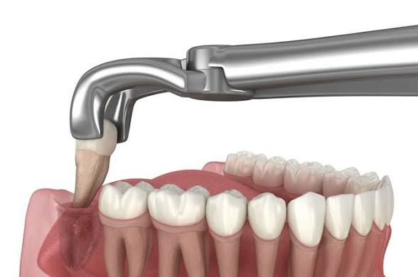 Dental Extraction