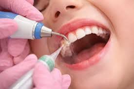 Cleaning Of Teeth