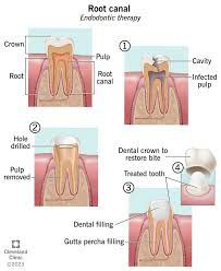 Root Canal Treatment