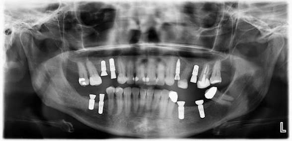 Dental Opg